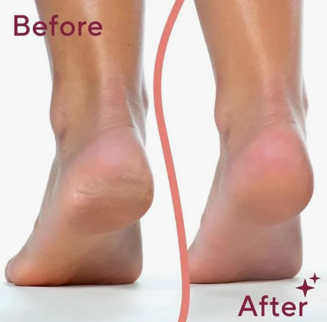 Electric Foot & Heel Callus Remover – Rechargeable Pedicure Tool